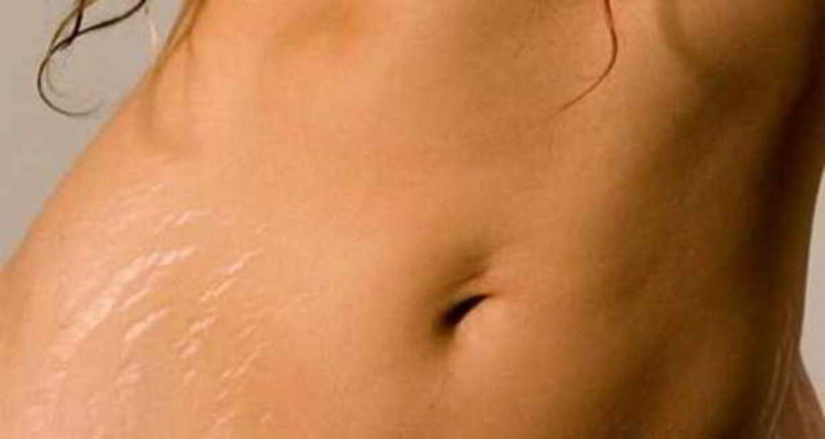 Ραγάδες: 4 «τρικ» για να τις απομακρύνετε οριστικά