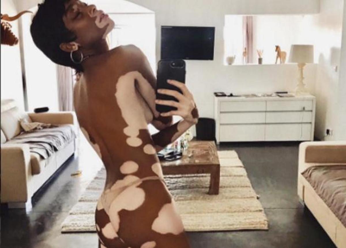 Winnie Harlow: Συγκλονίζει το μοντέλο με τη λεύκη! Ποζάρει γυμνή και δηλώνει ότι δεν την νοιάζει η γνώμη των άλλων! [pics]