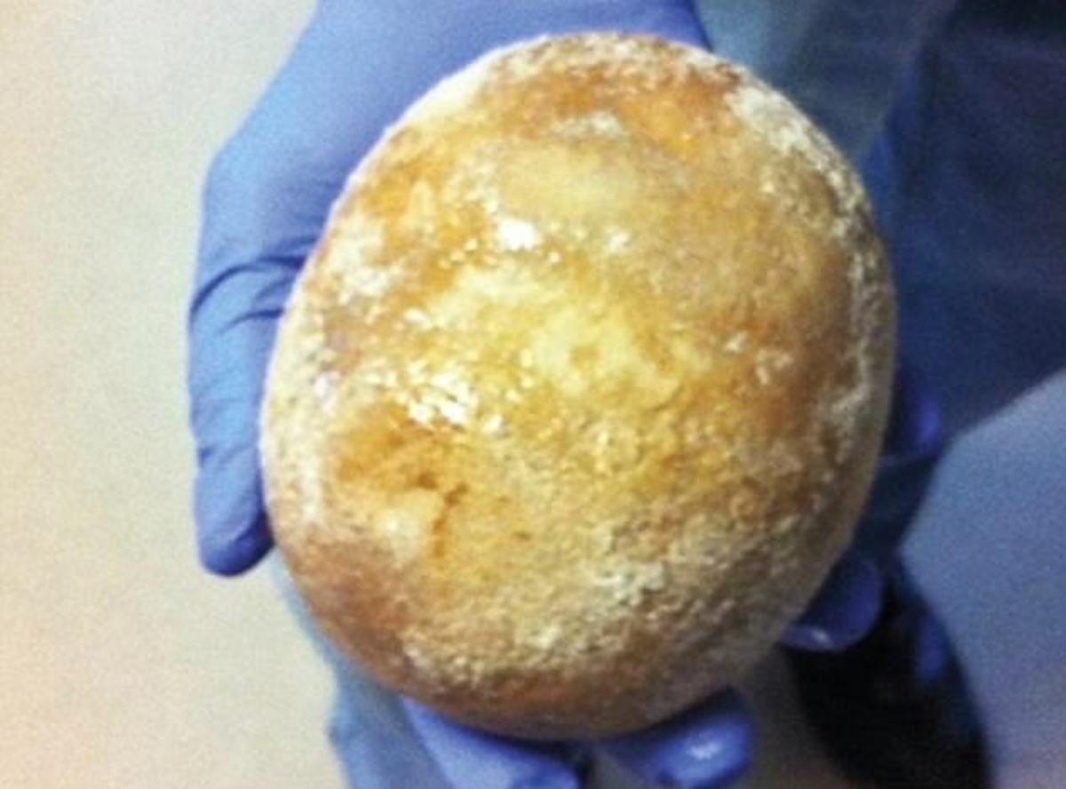 Του αφαίρεσαν πέτρα στην ουροδόχο κύστη που ήταν σαν… αυγό στρουθοκάμηλου! – Άναυδοι οι χειρουργοί [pics]