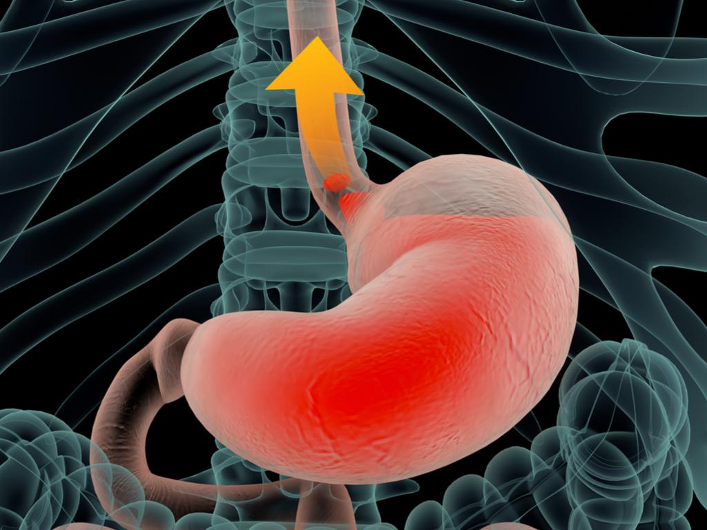 Γαστροοισοφαγική παλινδρόμηση: Τι ισχύει με την Μεσογειακή διατροφή – Νέα έρευνα