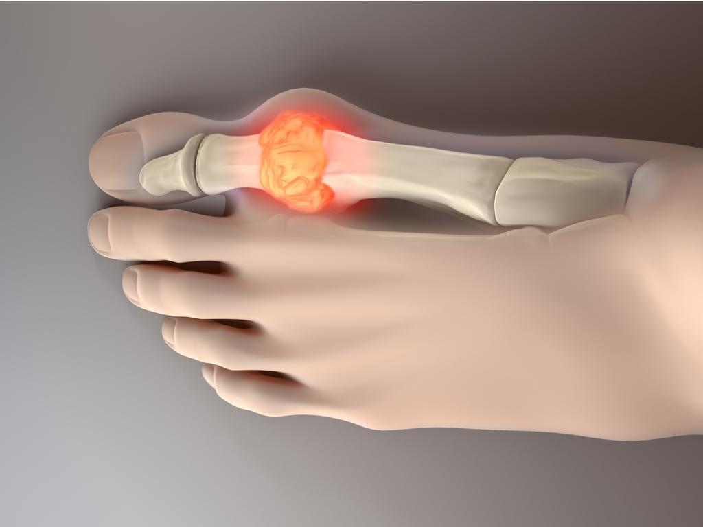 Μην υποτιμάτε το ουρικό οξύ – Ποιοι κινδυνεύουν και τι λύσεις υπάρχουν