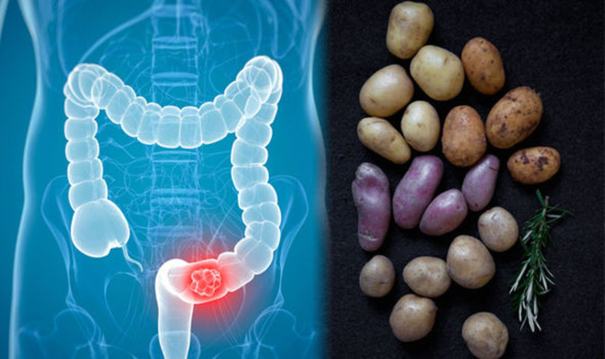Καρκίνος του παχέος εντέρου: Πώς συνδέεται με τις πατάτες που τρώτε