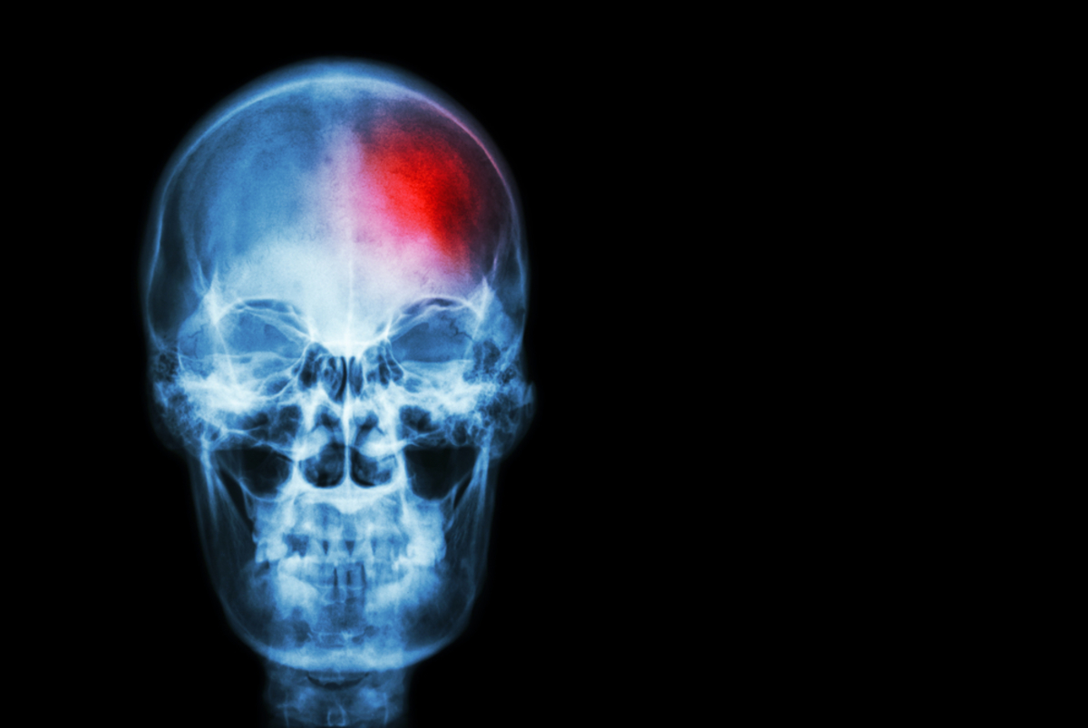 Mίνι εγκεφαλικό: Με ποια συμπτώματα χτυπάει