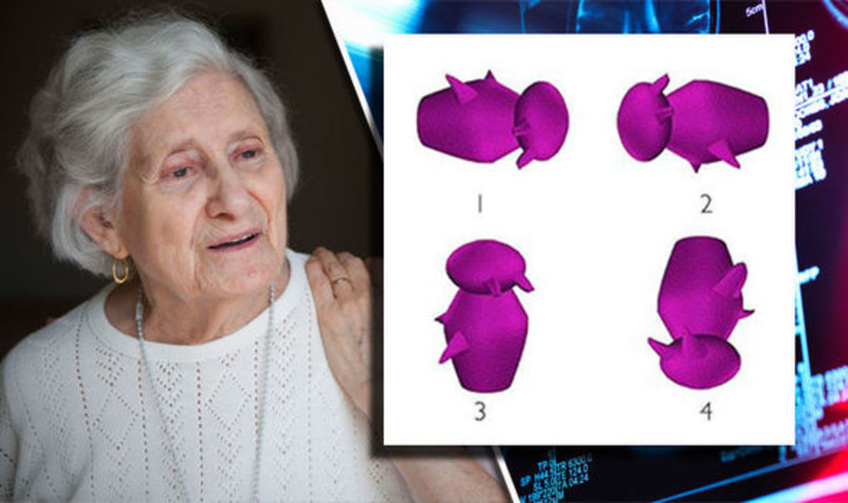 Τεστ για Αλτσχάιμερ: Βλέπετε ποιο σχήμα διαφέρει από τα άλλα; Τι λένε επιστήμονες! [pics]