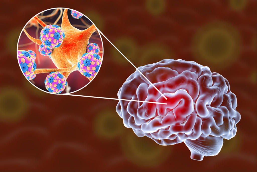 Εγκεφαλίτιδα: Αίτια, συμπτώματα και αντιμετώπιση της επικίνδυνης νόσου