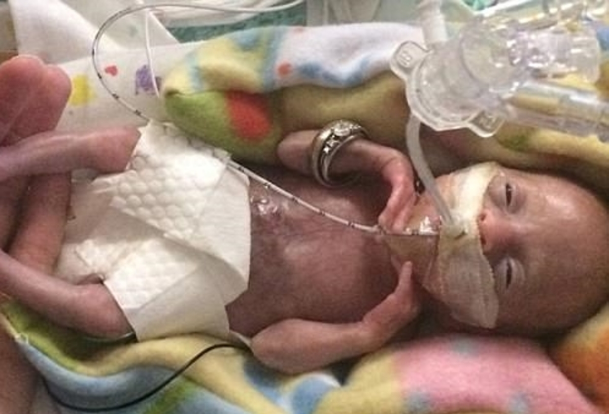 Δείτε το πιο πρόωρο βρέφος στην ιστορία – Ζύγιζε μόλις 425 γραμμάρια!