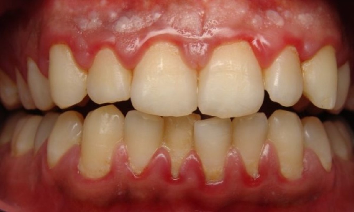 Διαβήτης: Σοκ από τις συνέπειες στην στοματική υγεία των ασθενών