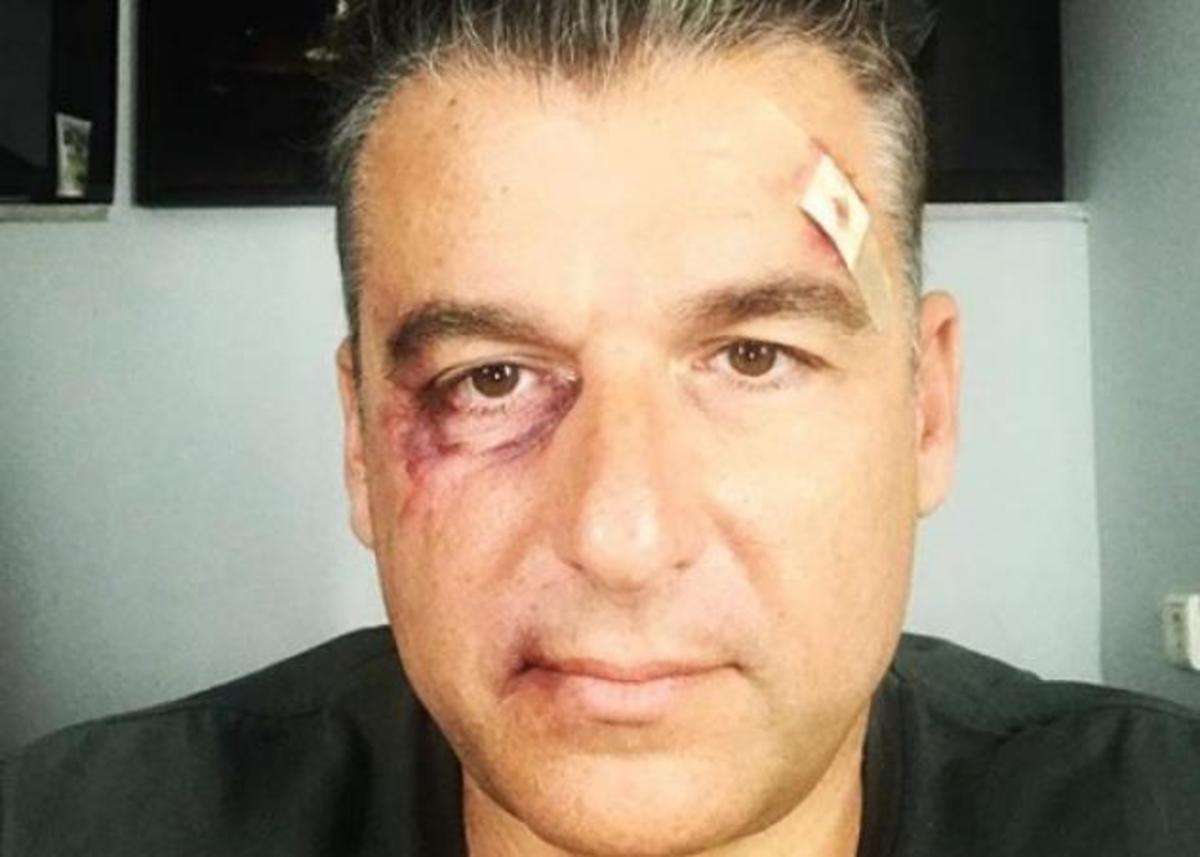 Γιώργος Λιάγκας: Η φωτογραφία με μαυρισμένο μάτι που τρόμαξε πολλούς!