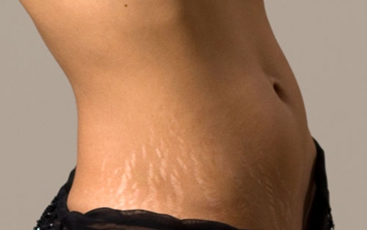 Επαναστατική τεχνολογία για ουλές και ραβδώσεις στο δέρμα!