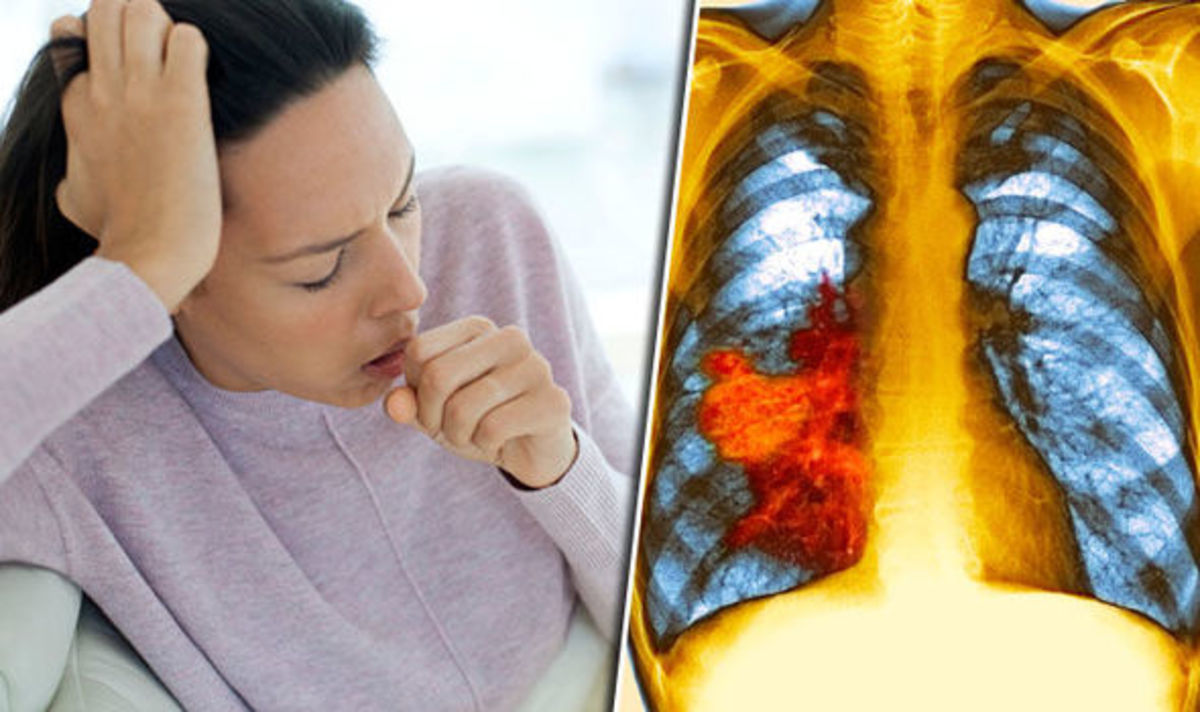 Καρκίνος του πνεύμονα – Συμπτώματα: Ο βήχας και η κόπωση μπορεί να είναι σημάδια