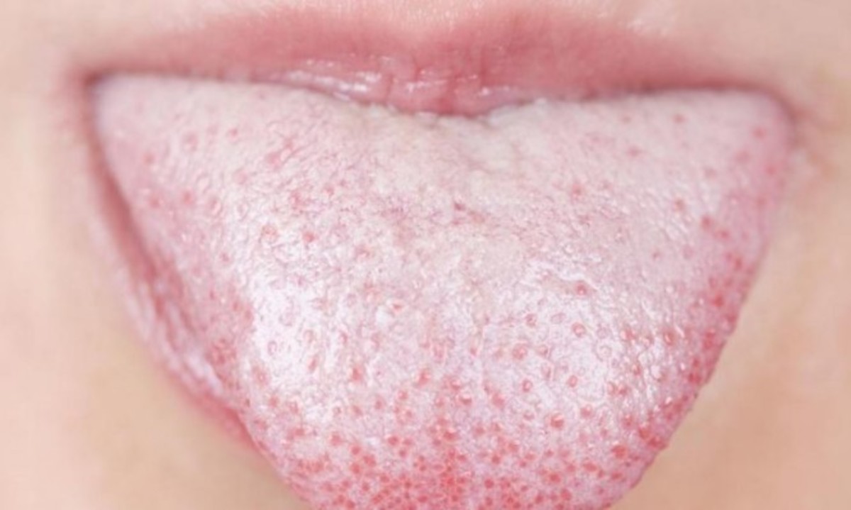 Τι μπορεί να είναι τα κόκκινα σημάδια στη γλώσσα – Όλες οι πιθανές ασθένειες