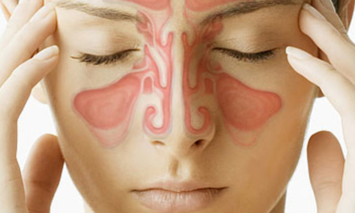 Ιγμορίτιδα: Πόσο διαρκεί – Τι να κάνετε για πονοκέφαλο και μπούκωμα