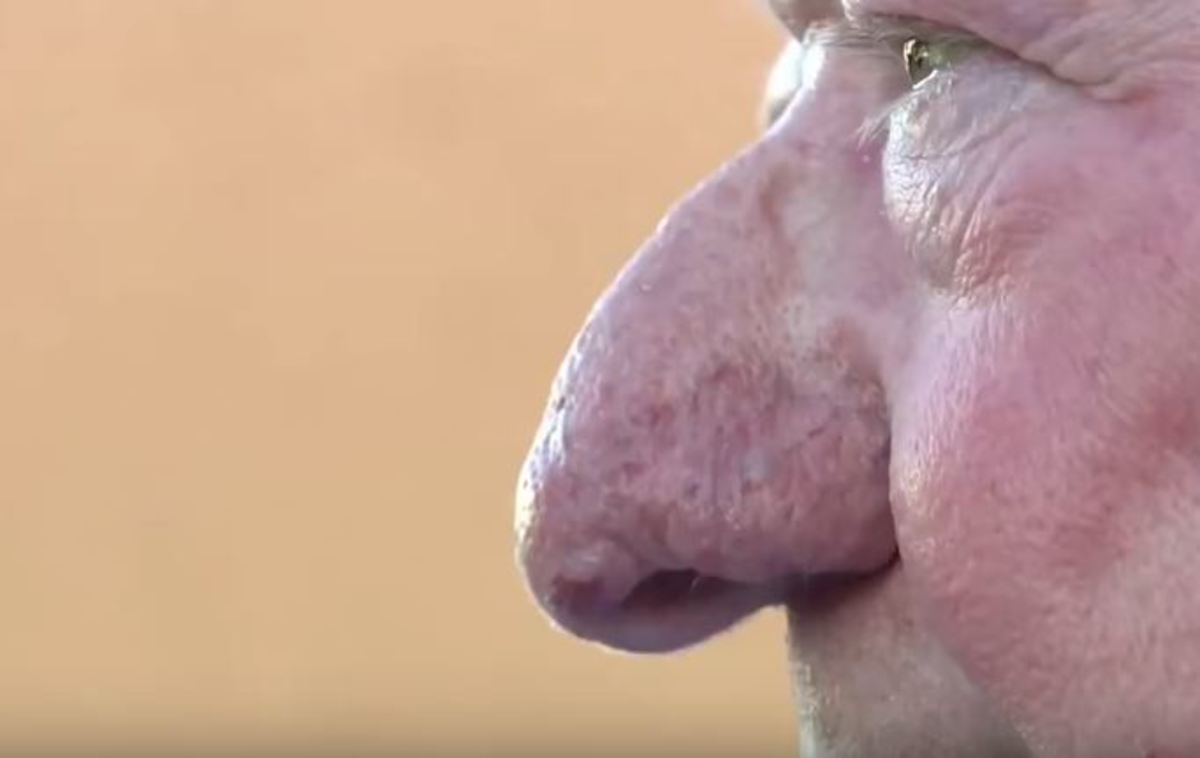 Διαγωνισμός για την πιο μεγάλη μύτη του κόσμου