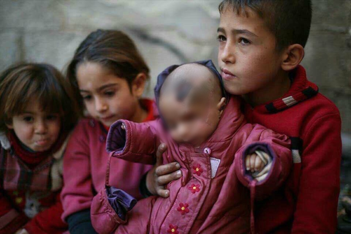 Μωρό από την Συρία έχασε το ένα του μάτι σε αεροπορική επιδρομή