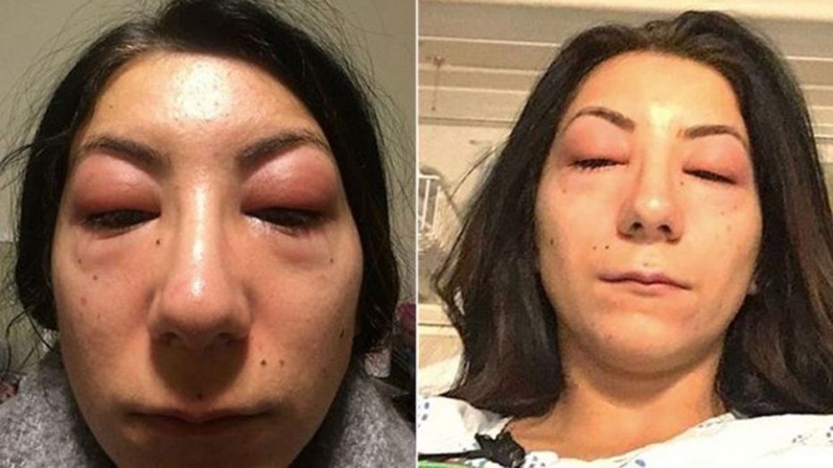 Δείτε τι έπαθε στα μάτια από τις ψεύτικες βλεφαρίδες που έβαλε!