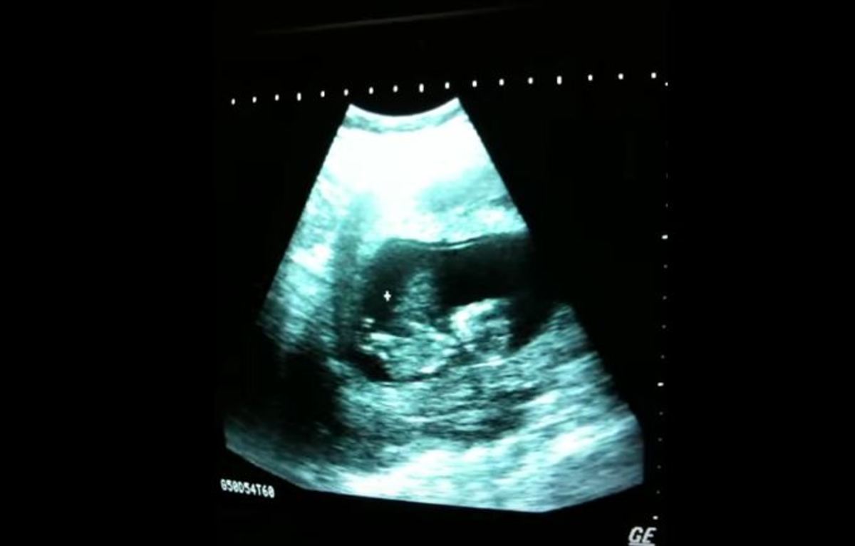 Απίστευτο βίντεο με δραστήριο έμβρυο που παίζει μέσα στην κοιλιά της μαμάς του!