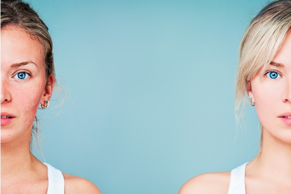 Τι να κάνετε για τα σημάδια από ακμή και σπυράκια: Βασικός οδηγός