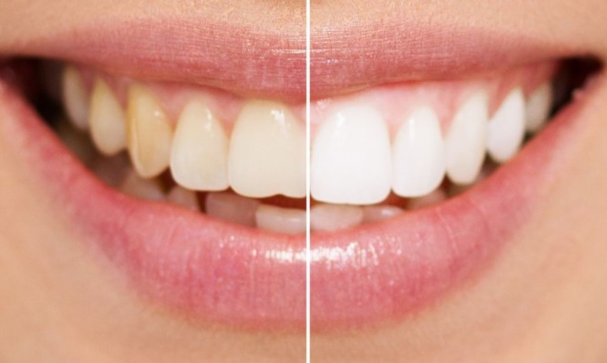 Πιο λευκά δόντια: Κάντε μπουκώματα με αυτό το φυσικό διάλυμα