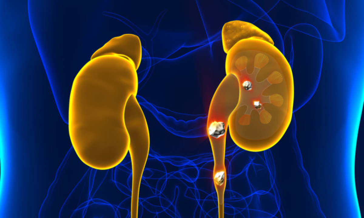 Πέτρες στους νεφρούς – Διατροφή: Αυτές οι τροφές σας προστατεύουν – Τι να προσέχετε όμως