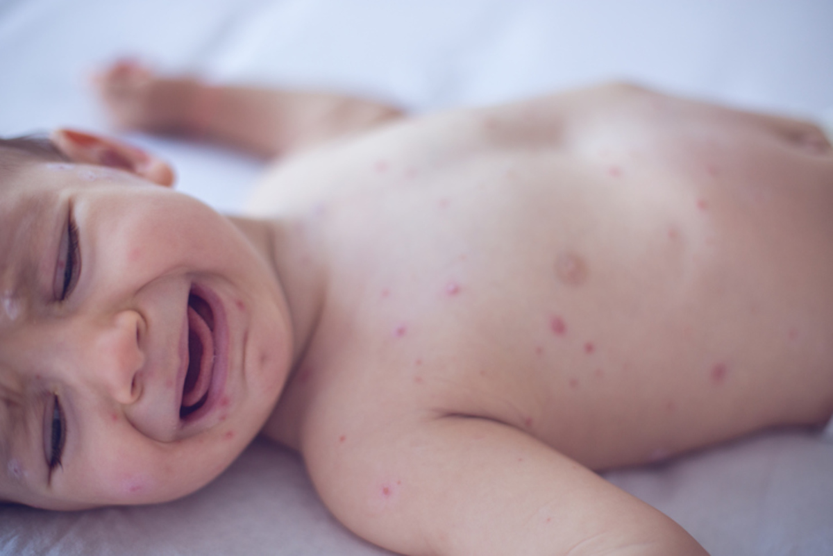 Θερίζει όλη την Ευρώπη η ιλαρά: Άυξηση 400% στα κρούσματα – Κραυγή των ειδικών για εμβολιασμό