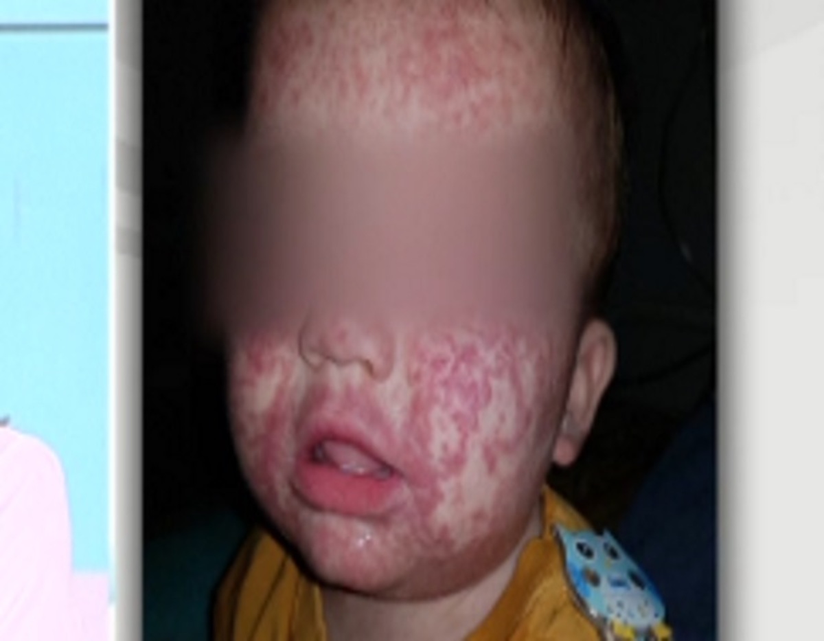"Έτσι κόλλησαν το παιδί μου ιλαρά μέσα στο νοσοκομείο"! Ξεσπάει ο πατέρας του 11 μηνών μωρού [vid]