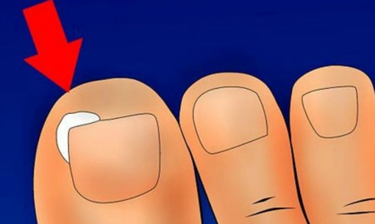 Νύχι που μπαίνει στο δέρμα: Αίτια, επιπτώσεις και αντιμετώπιση στο σπίτι