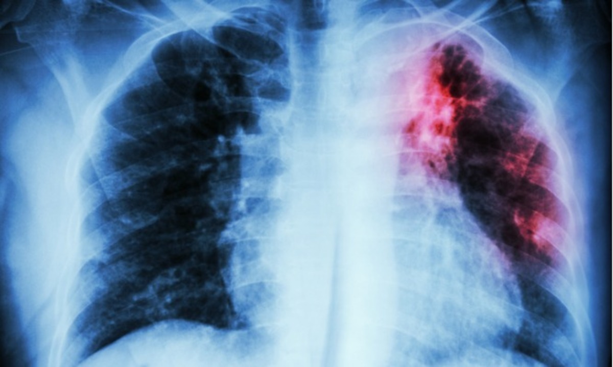 Παγκόσμια Ημέρα Φυματίωσης: Πώς εκδηλώνεται η φυματίωση – Ο #1 μολυσματικός «δολοφόνος» παγκοσμίως