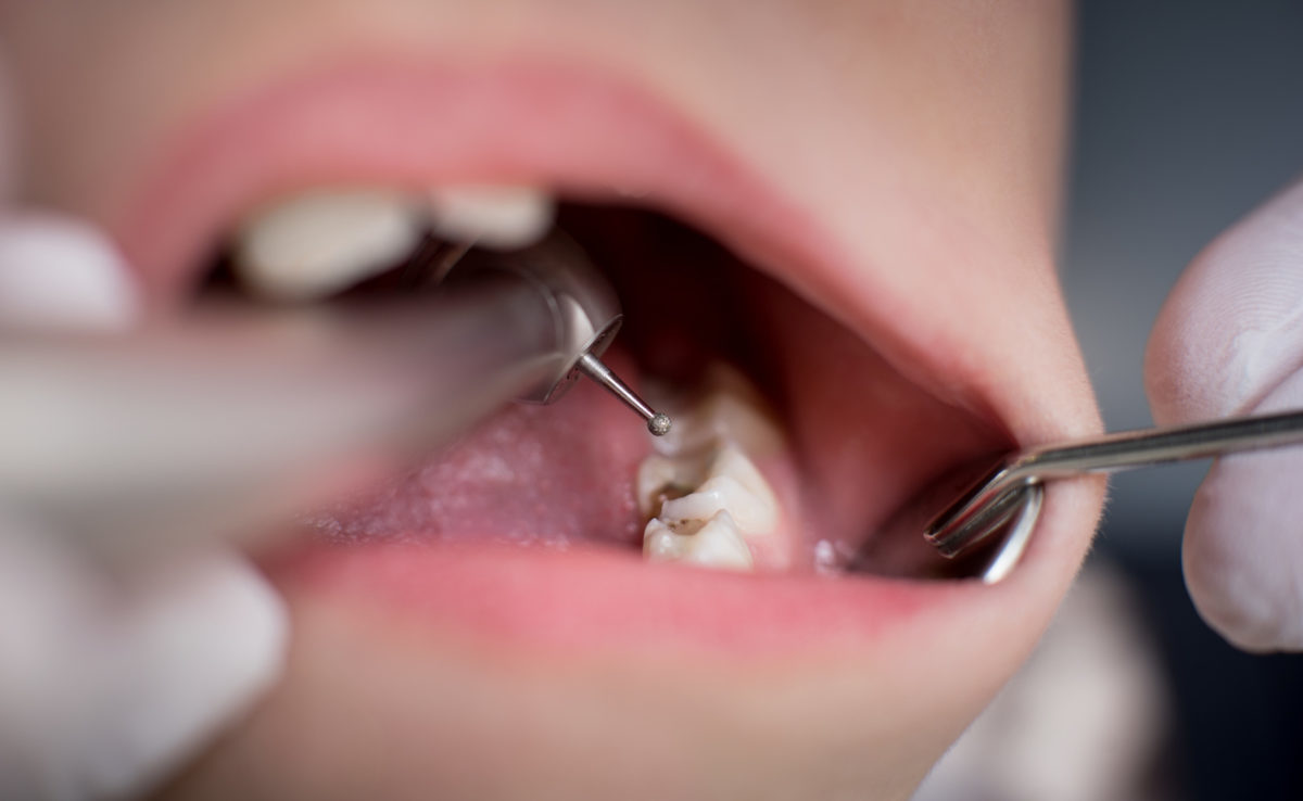 Τρύπες στα δόντια: Πώς και γιατί δημιουργούνται