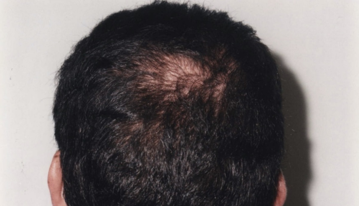 Έβαλε καρβουνάκι στη φαλάκρα για το γύρισμα και μαύρισε το πρόσωπο της ηθοποιού που έπαιζαν μαζί!