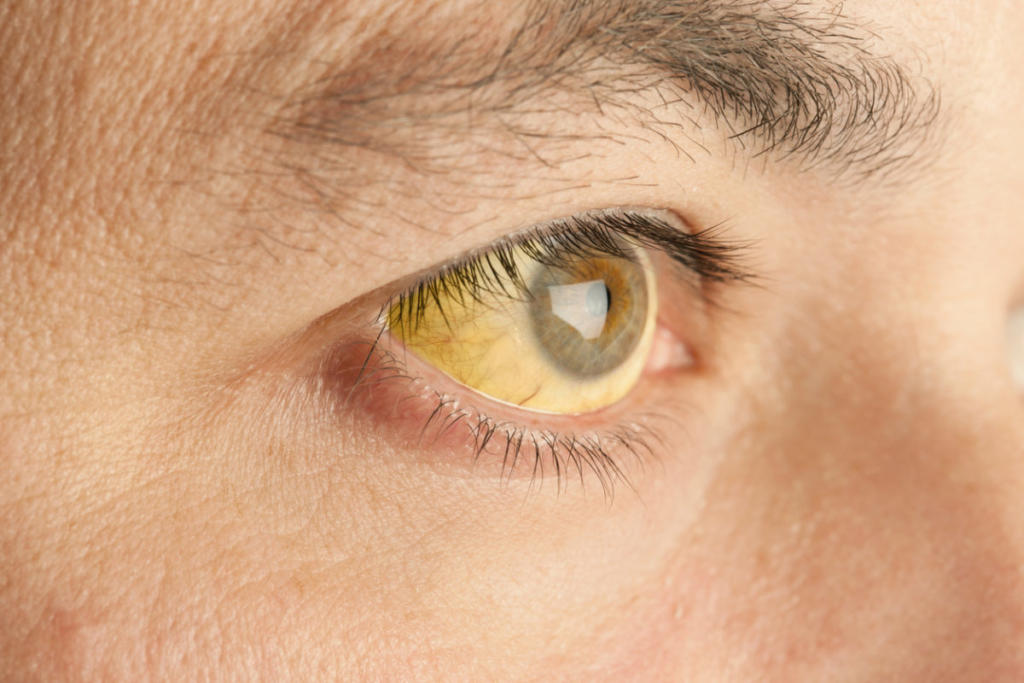 Τι σημαίνει αν κιτρινίζουν τα μάτια – Ποιες ασθένειες ίσως κρύβει το φαινόμενο