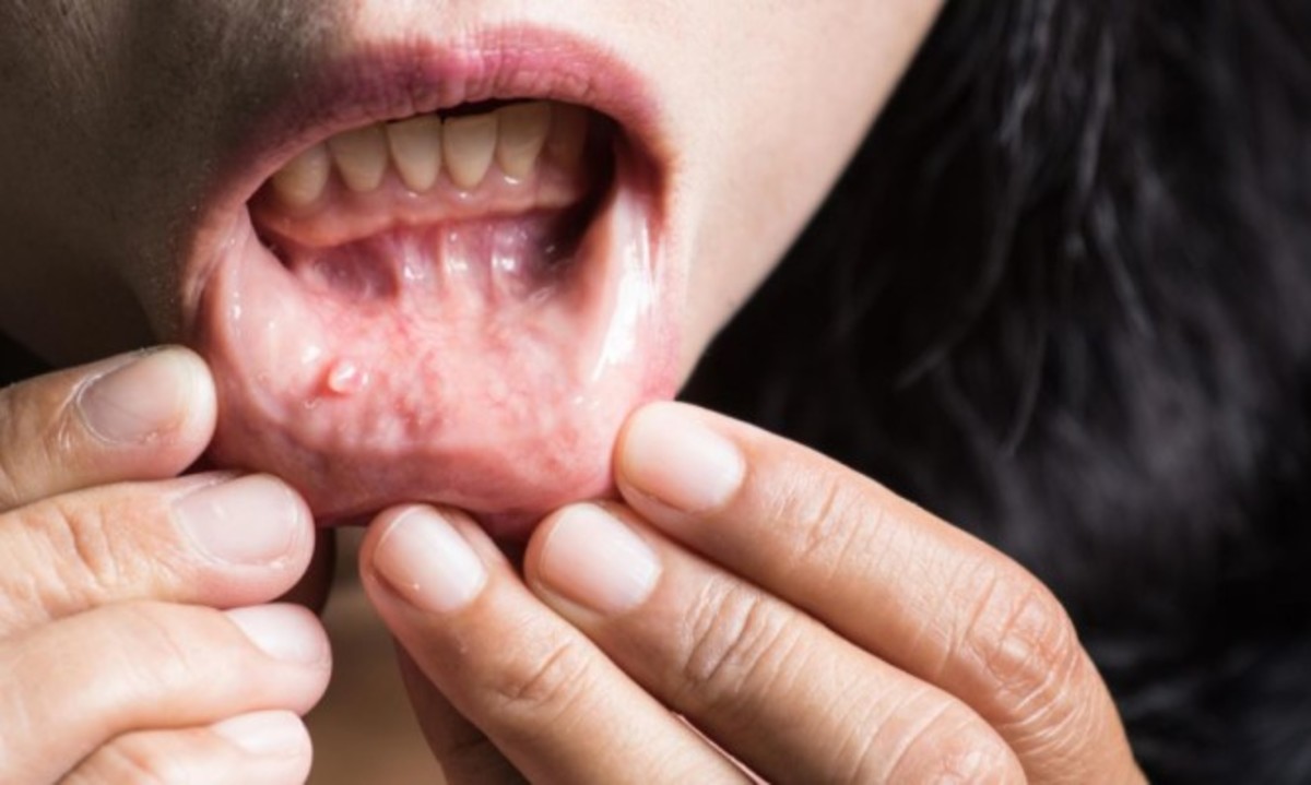 Προσοχή στα “αθώα” συμπτώματα που παρουσιάζει αρχικά ο καρκίνος του στόματος