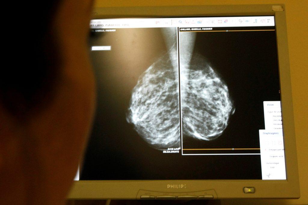 Σάλος στη Βρετανία! Από λάθος δεν κάλεσαν 450.000 γυναίκες να κάνουν μαστογραφία – 150.000 έχουν ήδη πεθάνει