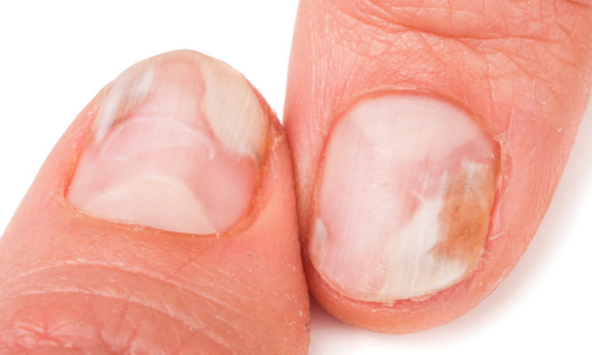 Μύκητες στα νύχια χεριών και ποδιών: Οι 8 κανόνες πρόληψης
