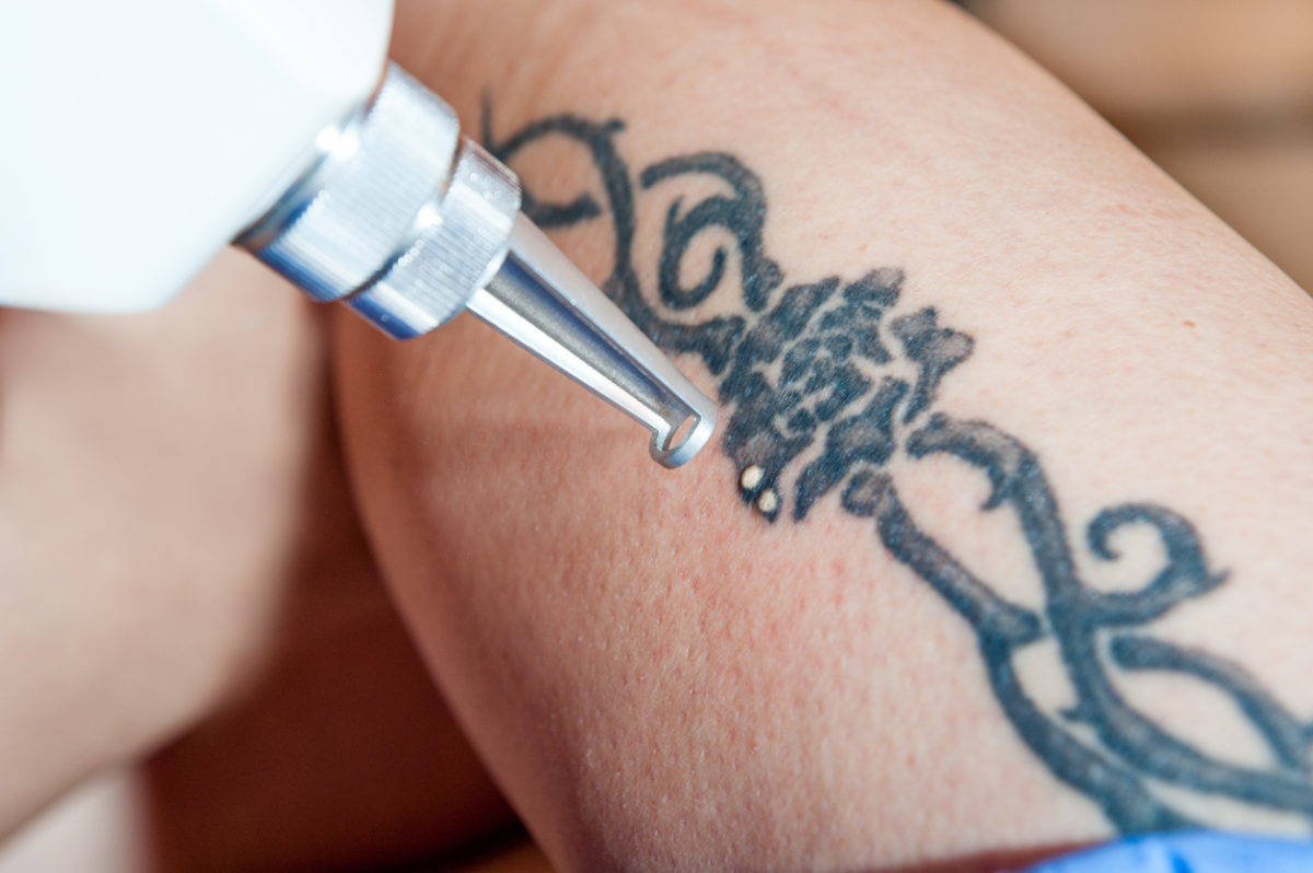Μετανιώσατε για κάποιο τατουάζ; Δείτε πώς γίνεται αφαίρεση με λέιζερ [vids]