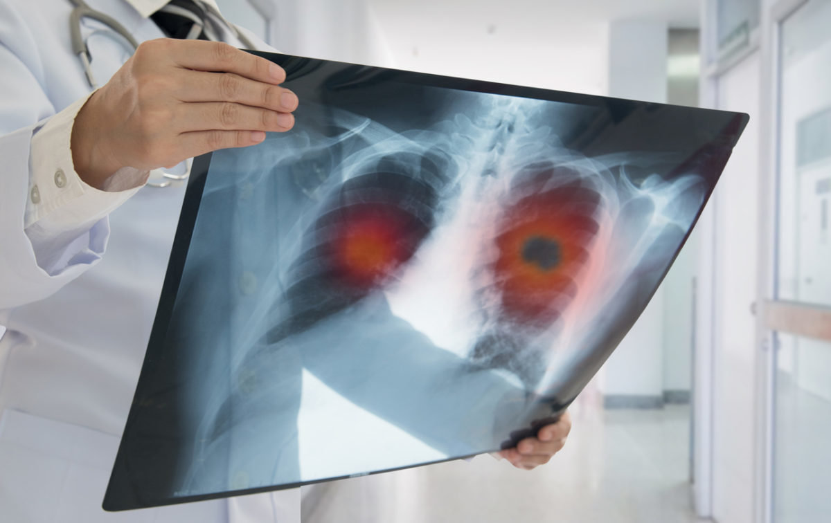 Καρκίνος του πνεύμονα: Προσοχή αν δείτε αυτή την αλλαγή στον βήχα σας