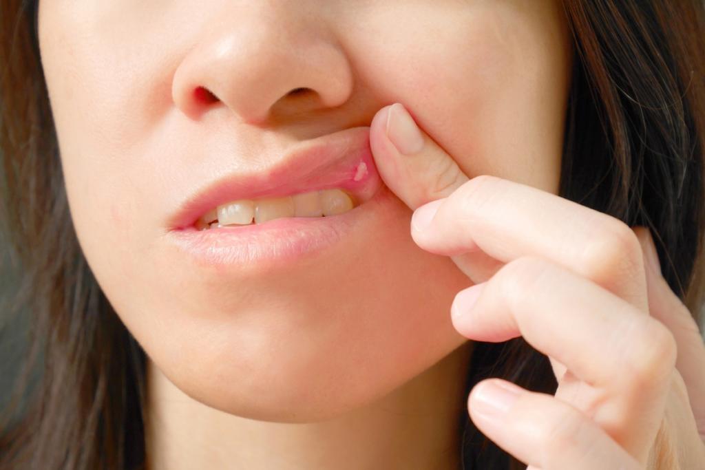Τι να κάνετε για τις άφθες στο στόμα – Γιατί εμφανίζονται εξαρχής