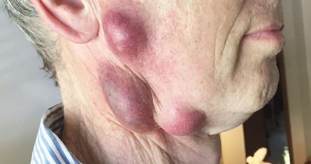 Έγινε ΕΤΣΙ από βακτήριο που του μετέδωσε η γάτα του – Τι είναι η αδενική τουλαραιμία