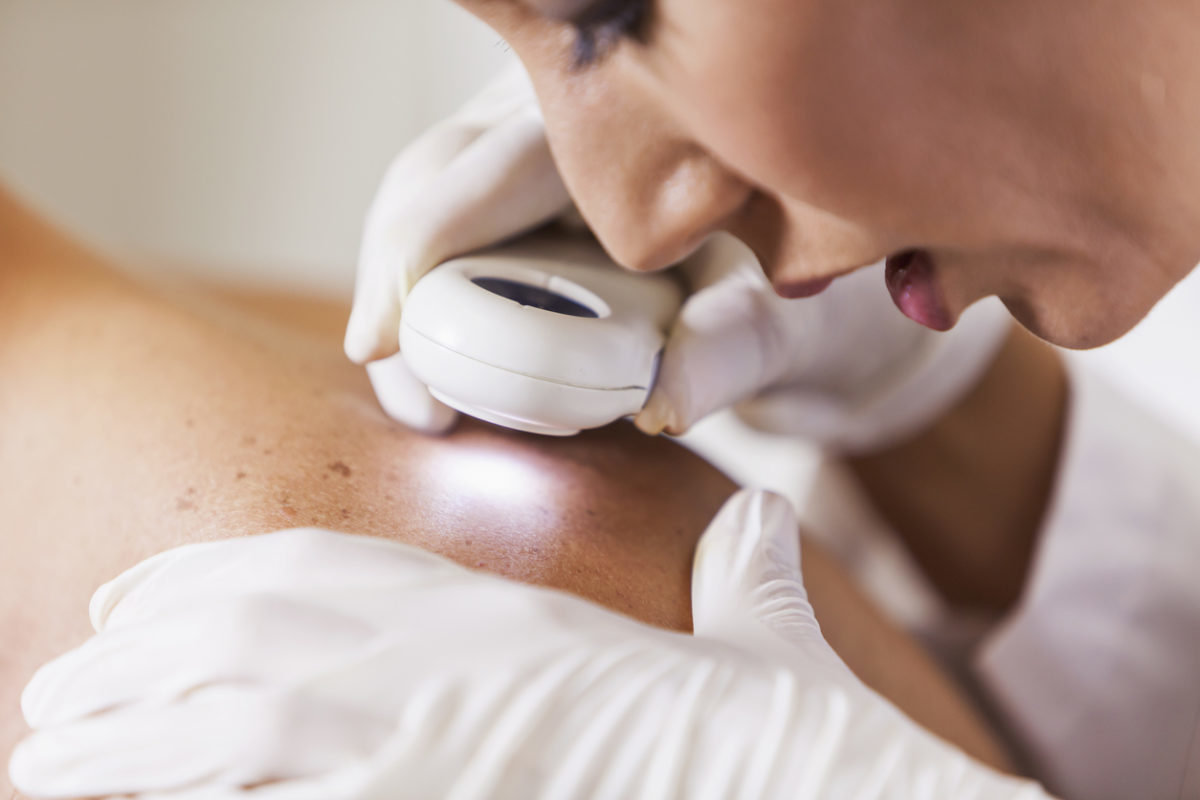 Καρκίνος του δέρματος: Γιατί ΤΩΡΑ είναι η πιο κατάλληλη εποχή για προληπτικό δερματολογικό έλεγχο