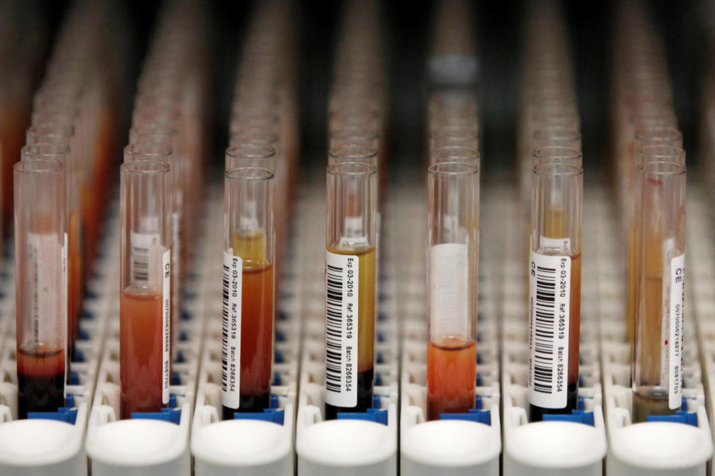 Σπουδαία ανακάλυψη: Νέο τεστ αίματος για την Πολλαπλή Σκλήρυνση – Μπορεί να προβλέπει την εξέλιξή της