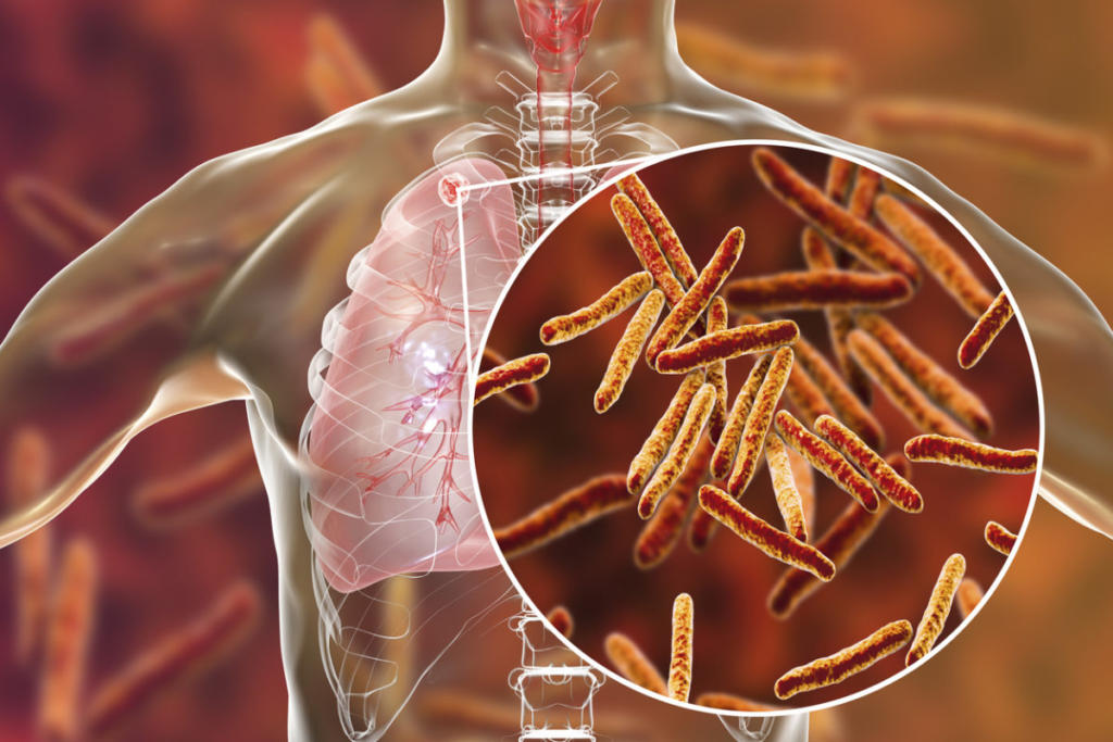 Τι πρέπει να ξέρετε για την φυματίωση: Συμπτώματα, πώς κολλάει και τι θεραπεία έχει