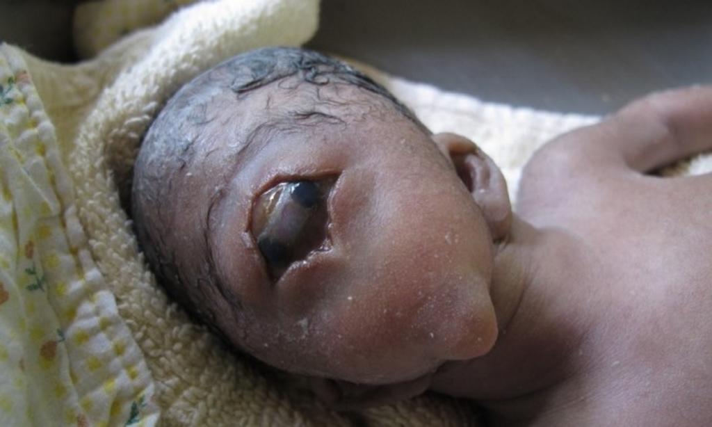 Οι 5 πιο σοκαριστικές γενετικές μεταλλάξεις σε ανθρώπους