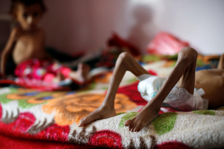 Θάνατος σε ηλικία επτά ετών – Πέθανε η Αμάλ, το κορίτσι σύμβολο του λιμού στην Υεμένη