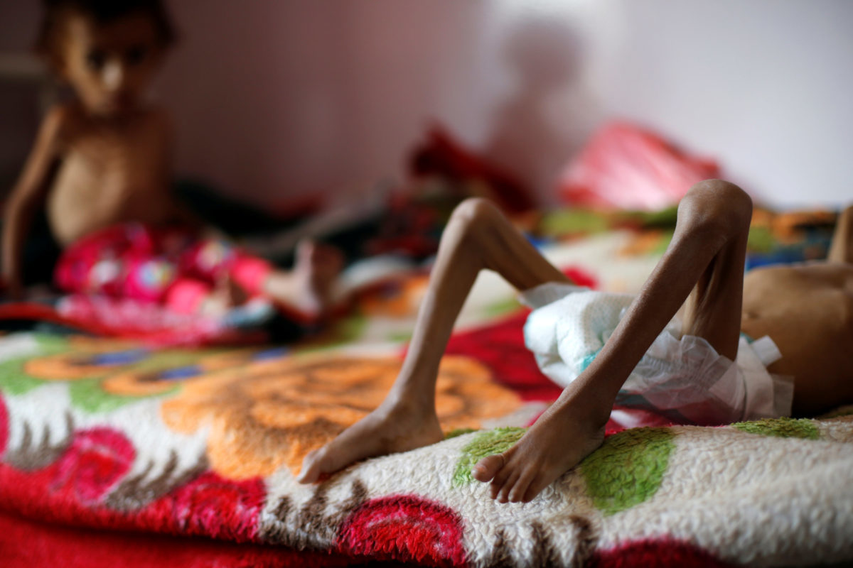 Θρήνος για το κορίτσι σύμβολο της ανθρωπιστικής κρίσης στην Υεμένη