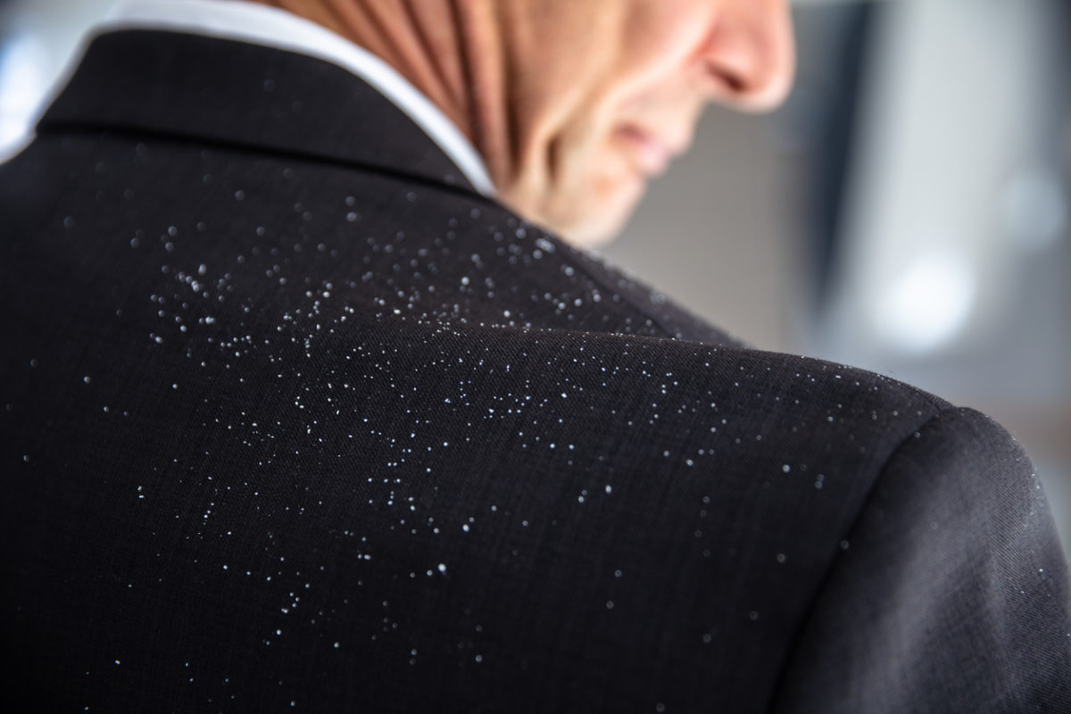 Άσπρες νιφάδες στα μαλλιά: Πότε είναι πιτυρίδα και πότε ξηροδερμία