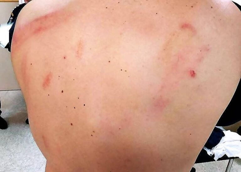 Συλλαλητήριο: Σοκάρουν οι φωτογραφίες των αστυνομικών που τραυματίστηκαν! | Newsit.gr Συλλαλητήριο: Σοκάρουν οι φωτογραφίες των αστυνομικών που τραυματίστηκαν! | Newsit.gr