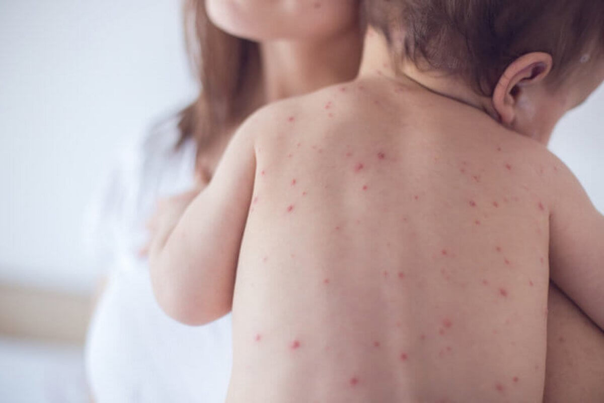 Νέα Υόρκη: Σε «καραντίνα» τα παιδιά που δεν έχουν εμβολιαστεί για ιλαρά