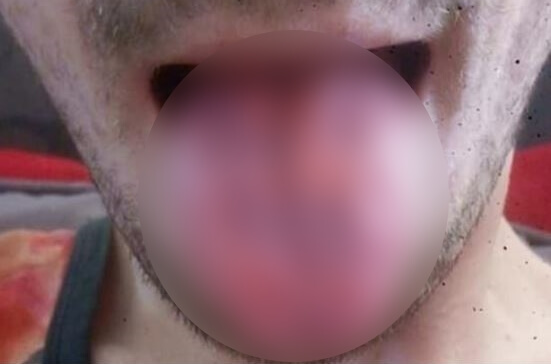 Έπινε δέκα “ενεργειακά ποτά” την ημέρα: Δείτε πώς έγινε η γλώσσα του! [pic]