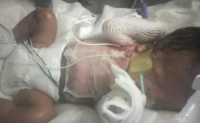 ΣΟΚ: Μωρό γεννήθηκε χωρίς δέρμα – Σαστισμένοι οι γιατροί! [pics]