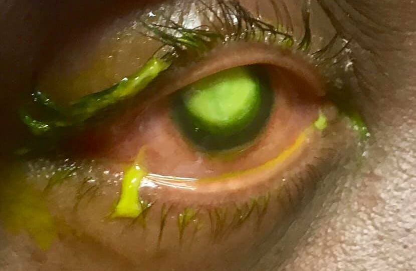 Μην κοιμάστε με τους φακούς επαφής: Εικόνες-ΣΟΚ που δημοσίευσε ένας οφθαλμίατρος