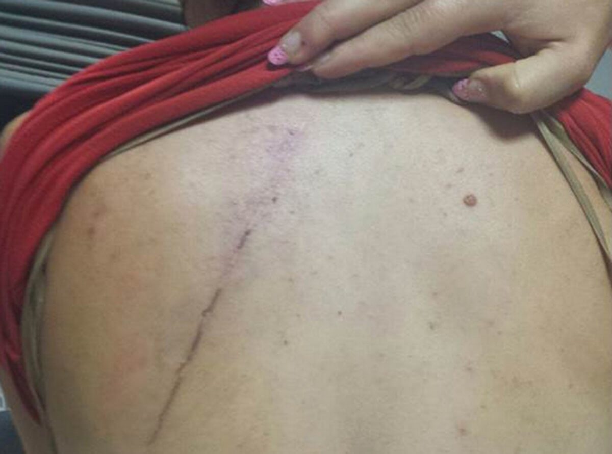 Ηράκλειο: Της έκοψε τα μαλλιά και τη βίασε – Ανατριχίλα από τα σημάδια της κακοποίησης στο σώμα της γυναίκας [pics]